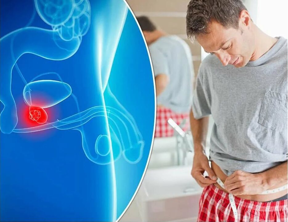 prostatīta simptomi un cēloņi