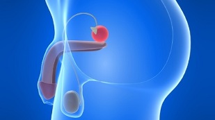 prostatas masāža prostatīta profilaksei