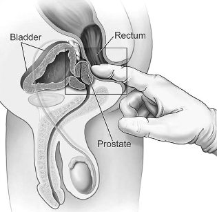 prostatīta ārstēšana mājās masāža