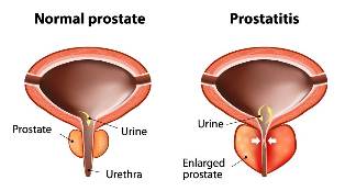 akūts prostatīts ārstēšana