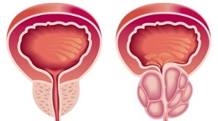 cēloņi prostatīta un prostatas adenomas attīstībai