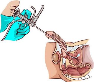 Ureteroskopijas procedūra